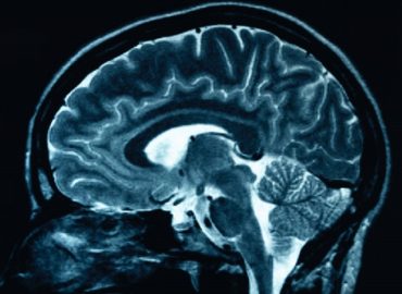 SMETTERE DI FUMARE DOPO ICTUS O TIA RIDUCE IL RISCHIO DI MORTALITA’ E EVENTI CARDIOVASCOLARI